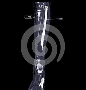 CTA femoral artery run  off MPR curve  showing Left  femoral artery for diagnostic  Acute or Chronic Peripheral Arterial Disease