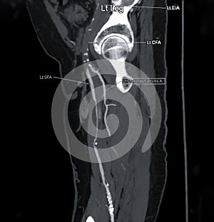 CTA femoral artery run  off MPR curve  showing Left  femoral artery for diagnostic  Acute or Chronic Peripheral Arterial Disease