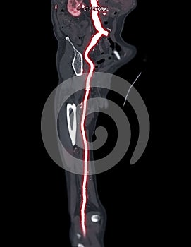 CTA femoral artery run  off MPR curve  showing Left  femoral artery for diagnostic  Acute or Chronic Peripheral Arterial Disease