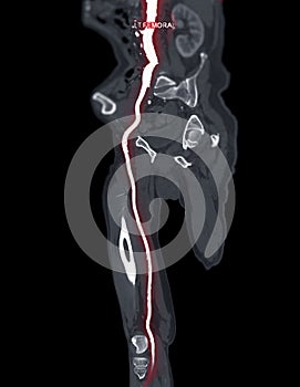 CTA femoral artery run  off MPR curve  showing Left  femoral artery for diagnostic  Acute or Chronic Peripheral Arterial Disease