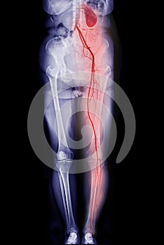 CTA femoral artery run off showing  femoral artery for diagnostic  Acute or Chronic Peripheral Arterial Disease