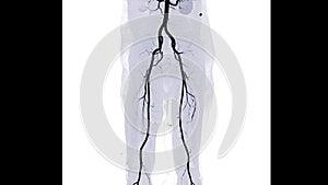 CTA femoral artery run off showing  femoral artery for diagnostic  Acute or Chronic Peripheral Arterial Disease