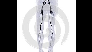 CTA femoral artery run off showing  femoral artery for diagnostic  Acute or Chronic Peripheral Arterial Disease