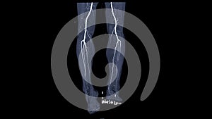 CTA femoral artery run off showing  femoral artery for diagnostic  Acute or Chronic Peripheral Arterial Disease