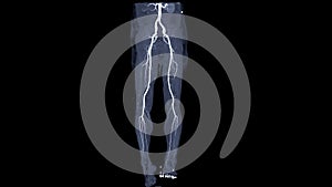 CTA femoral artery run off showing  femoral artery for diagnostic  Acute or Chronic Peripheral Arterial Disease