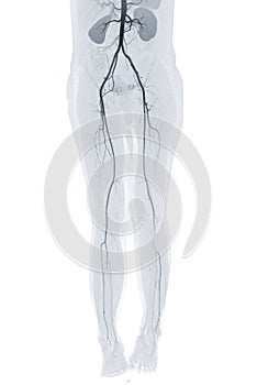 CTA femoral artery run off showing femoral artery  Presenting with Acute or Chronic Peripheral Arterial Disease