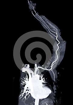 CTA left brachial artery or CT scan vessel of upper extremity