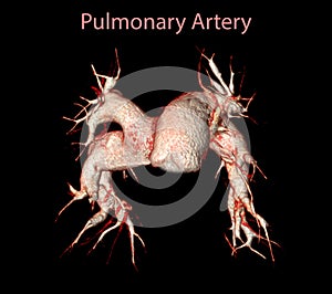 CTA pulmonary arteries 3D