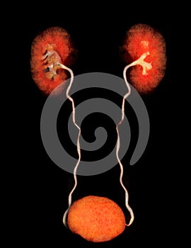 CTA Renal artery  3D rendering image  showing both kidney, Ureter and bladder