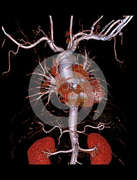 CTA thoracic aorta 3D rendering image photo