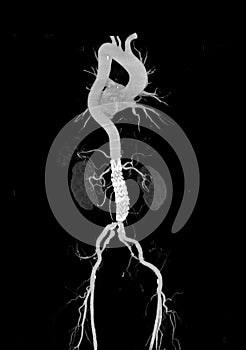 CTA whole aorta 3D rendering image.