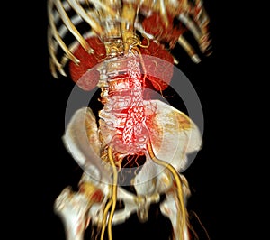 CTA whole aorta with Abdominal aorta stent graft compare 3D rendering image