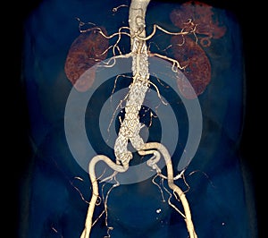 CTA whole aorta with Abdominal aorta stent graft compare 3D rendering image