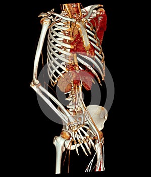 CTA whole aorta and brachial artery 3D rendering image in case patient tramatic