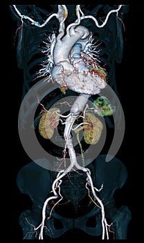 CTA Whole aorta 3D rendering image .