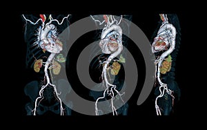 CTA Whole aorta 3D rendering image.