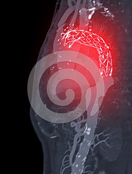 CTA whole aorta with thoracic aorta stent graft 3D rendering image .