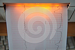 CTG device with monitoring of the state of health of the mother and child during childbirth in the hospital. Cardiotocograph