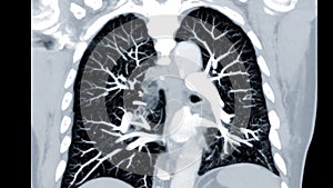 CTPA or CTA pulmonary artery .This imaging technique offers a clear view of the pulmonary arteries, aiding in the diagnosis of