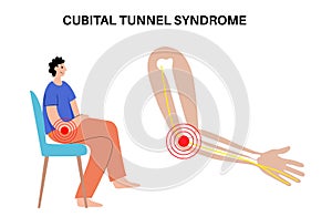 Cubital tunnel syndrome