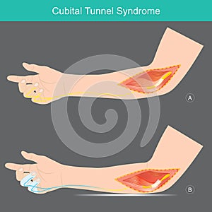 Cubital Tunnel Syndrome. photo