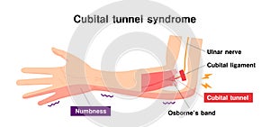 Cubital tunnel syndrome illustration