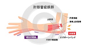 Cubital tunnel syndrome illustration