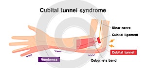 Cubital tunnel syndrome illustration photo