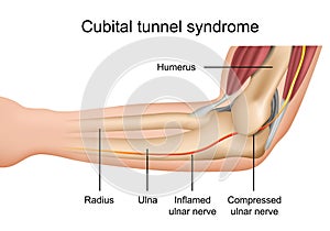 Cubital tunnel syndrome, inflamed ulnar nerve medical vector illustration on white background