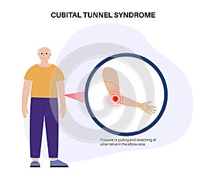 Cubital tunnel syndrome photo