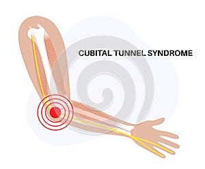 Cubital tunnel syndrome photo