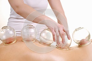 Cupping massage the back of a woman