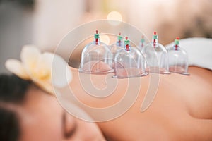 Cupping therapy, spa and zen woman for chinese alternative medicine treatment for back pain and health. Bodycare and