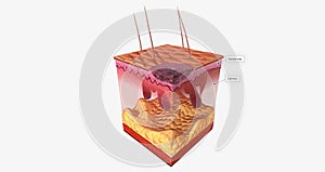 The Curettage and Electrodesiccation Close Up