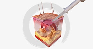 The Curettage and Electrodesiccation Close Up