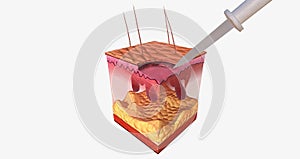 The Curettage and Electrodesiccation Close Up