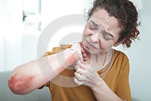 Curly woman feeling painful having rash and reddening on arm