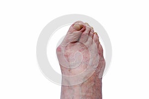 Curvature of the big toe