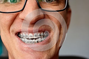 Curved teeth of guy with braces in glasses close up. Portrait of