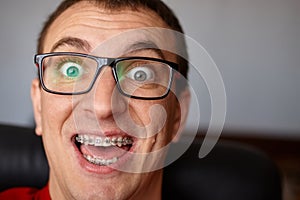 Curved teeth of guy with braces in glasses close up. Portrait of
