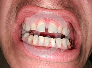 Curved teeth in a man`s mouth