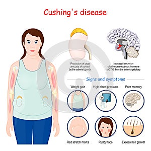 Cushing`s disease. Signs and symptoms of Cushing syndrome