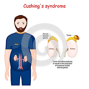 Cushing`s syndrome. Close-up of adrenal gland with tumor photo