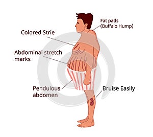Cushing syndrome symptoms. Illustration of the common features of the cushing disease