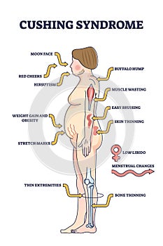 Cushing syndrome symptoms list from high cortisol level outline diagram
