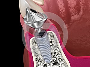 Custom abutment, dental implant and ceramic crown. Medically accurate tooth 3D illustration