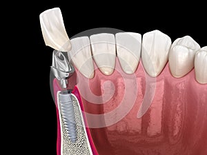 Custom abutment, dental implant and ceramic crown. Medically accurate tooth 3D illustration photo