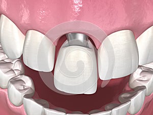 Custom abutment, dental implant and ceramic crown. Medically accurate tooth 3D illustration photo