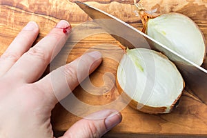 Cut injury, cut into fingers with onion