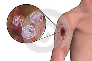 Cutaneous leishmaniasis ulcer and close-up view of Leishmania amastigotes